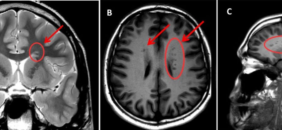 Gray matter &#8211; what is it? How it behaves? What is heterotopia?