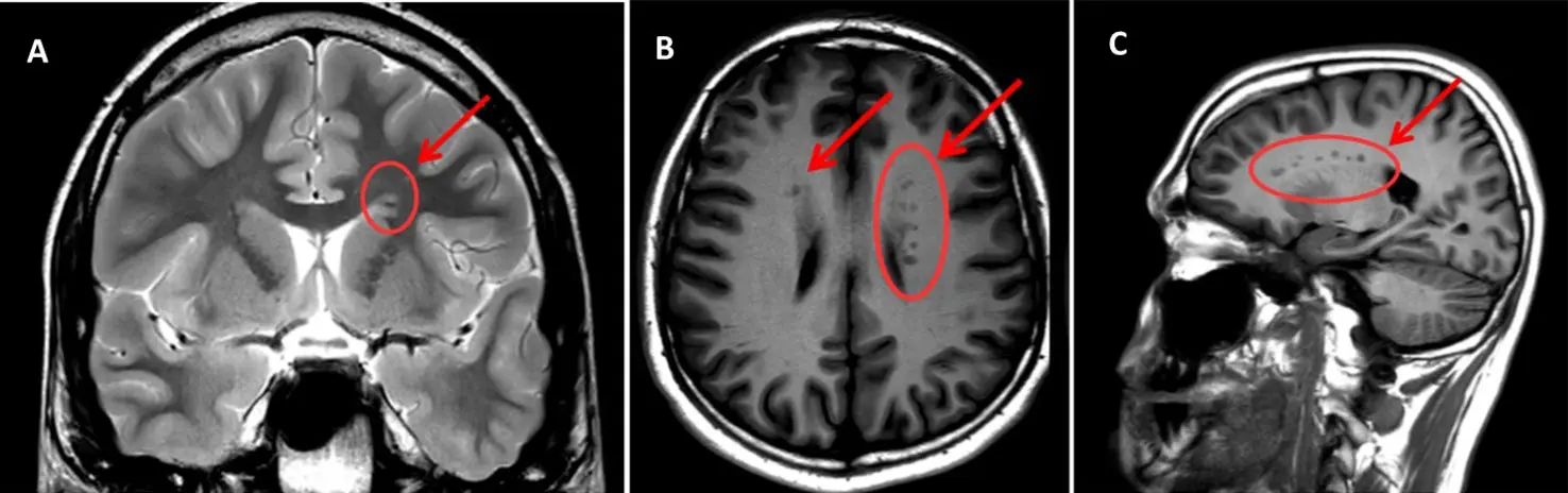 Gray matter &#8211; what is it? How it behaves? What is heterotopia?