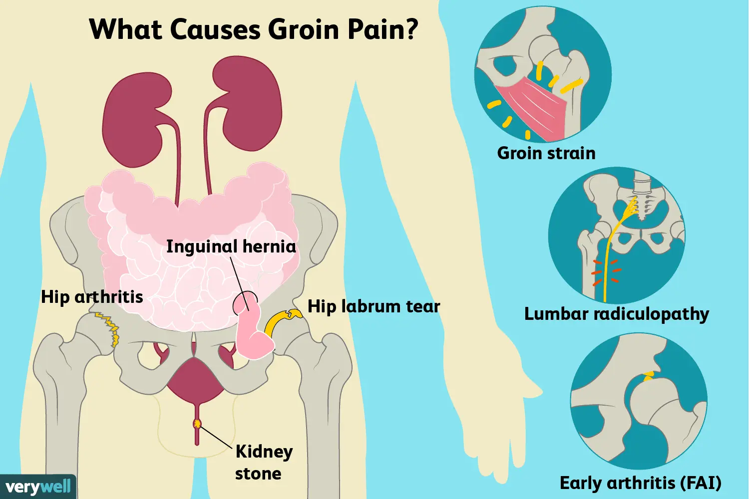 Groin pain &#8211; causes. When is pain in the left and right groin?