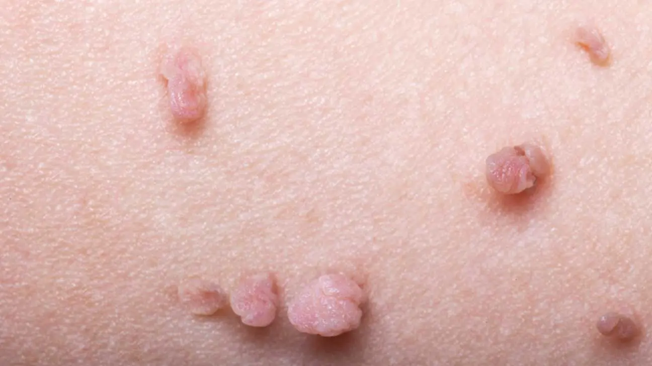 Growths on the skin &#8211; types, causes, symptoms, treatment