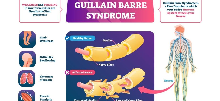 Guillain-Barré syndrome &#8211; causes, symptoms, treatment