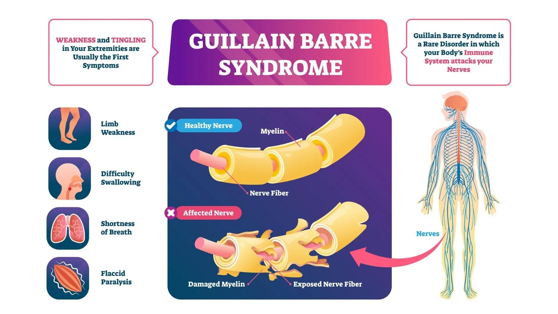 Guillain-Barré syndrome &#8211; causes, symptoms, treatment