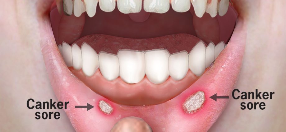 Gum canker sores &#8211; causes, treatment and prevention