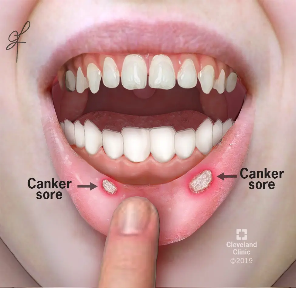 Gum canker sores &#8211; causes, treatment and prevention