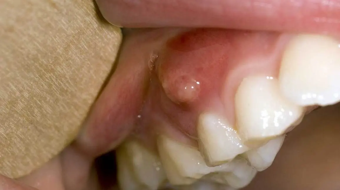 Gum tumors &#8211; causes, types, diagnosis. How To Treat Gum Lumps?