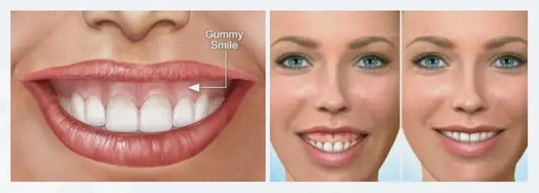 Gummy smile, or methods for a gummy smile