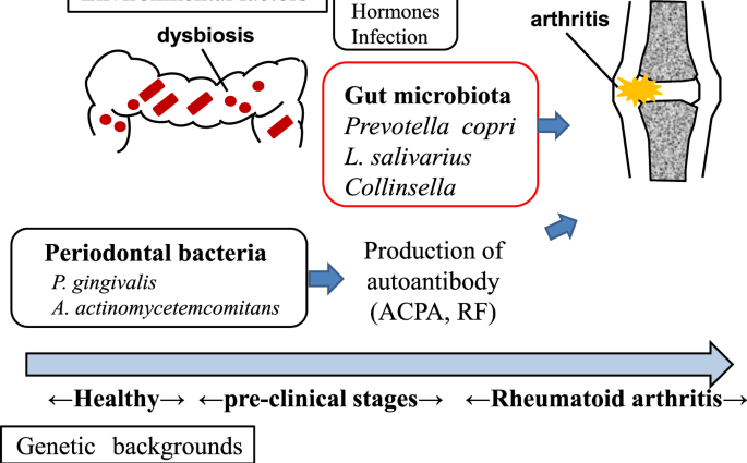 Gut bacteria can cause rheumatism