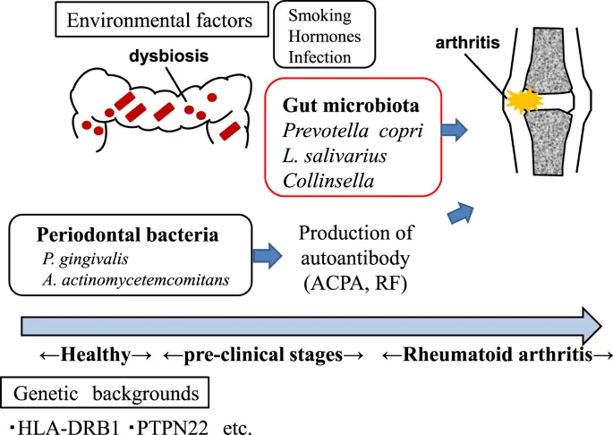 Gut bacteria can cause rheumatism