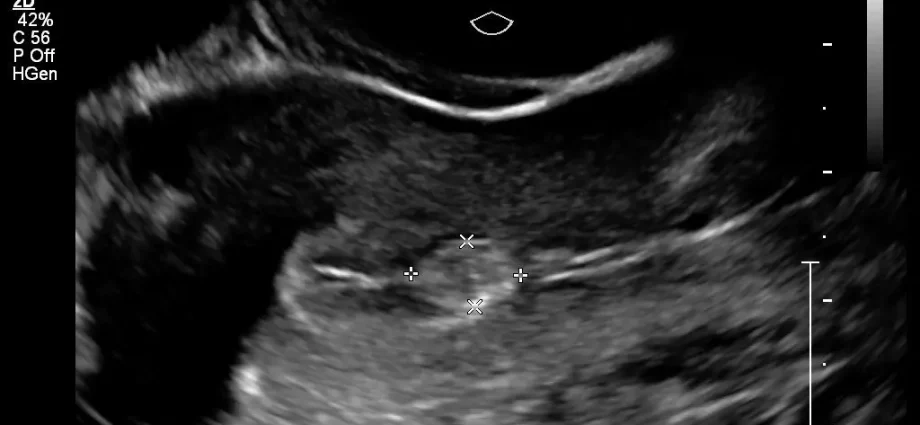 Gynecological ultrasound &#8211; what does it look like? When should a gynecological ultrasound be performed?