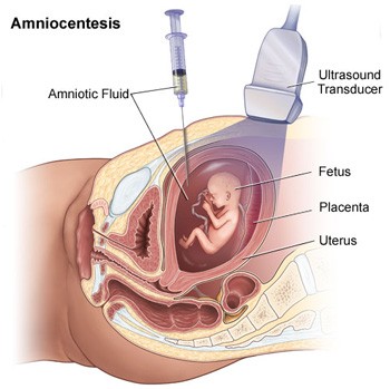 Gynecologist: there are many more fetuses with genetic defects