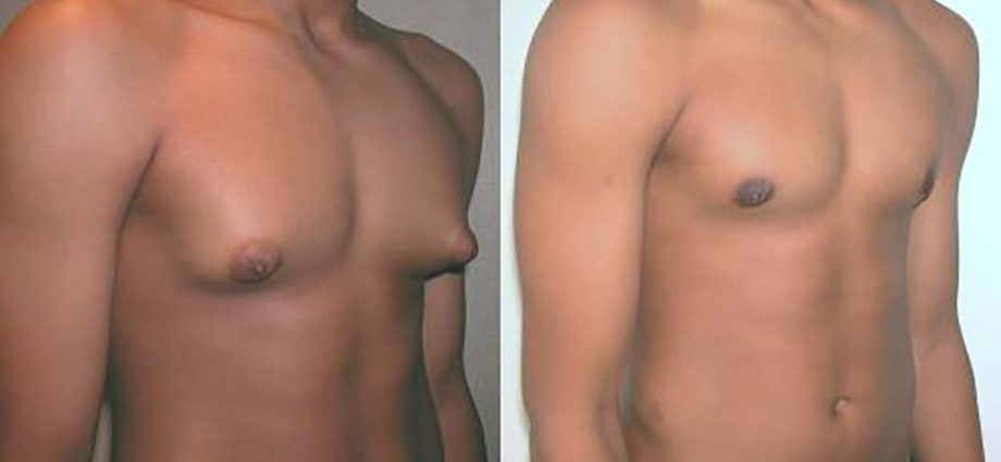 Gynecomastia &#8211; causes, symptoms, diagnosis, treatment