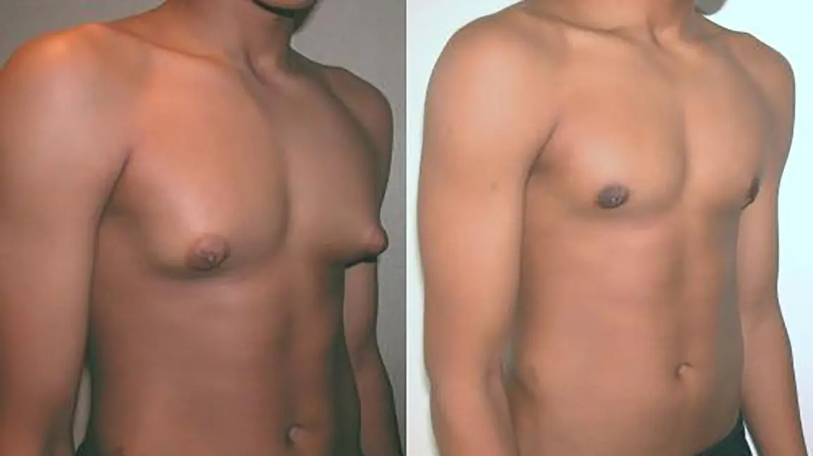 Gynecomastia &#8211; causes, symptoms, diagnosis, treatment