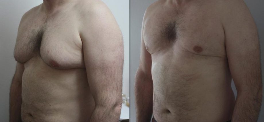 Gynecomastia, i.e. a man with breasts