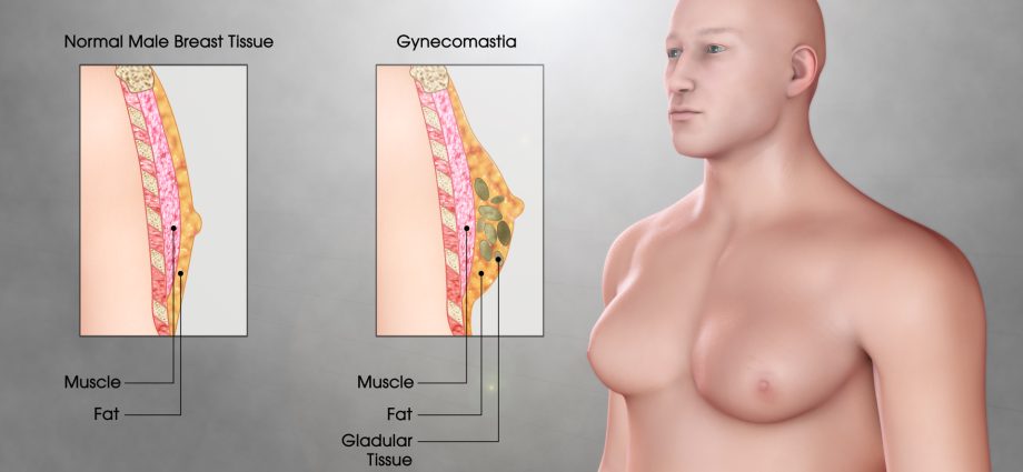 Gynecomastia &#8211; symptoms and diagnosis. What is the treatment of gynecomastia?