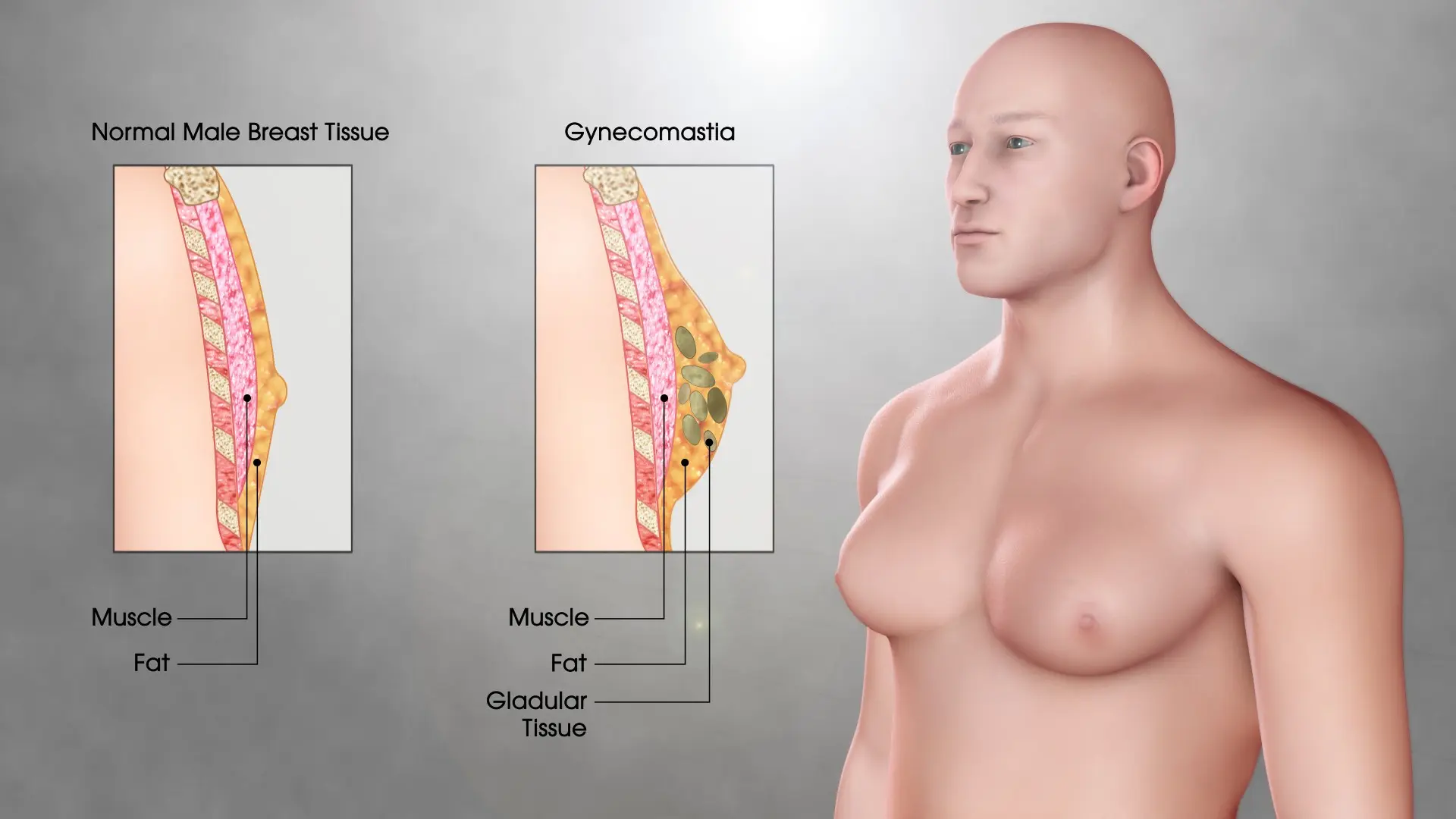 Gynecomastia &#8211; symptoms and diagnosis. What is the treatment of gynecomastia?