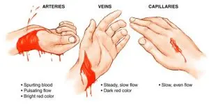 Haemorrhage &#8211; types and first aid