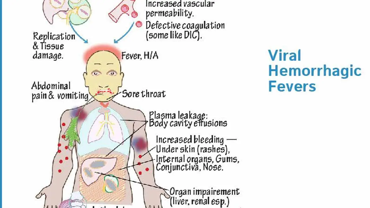 Haemorrhagic fever