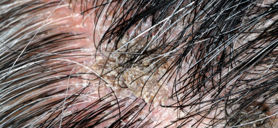 Hair wart &#8211; what is it?