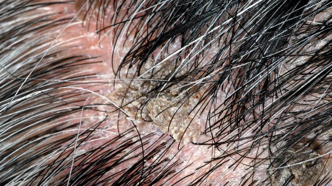 Hair wart &#8211; what is it?