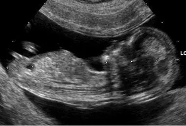 Half ultrasound &#8211; when should it be performed? Preparation and course of half ultrasound