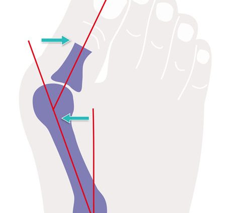 Hallux valgus &#8211; causes, symptoms and surgical treatment