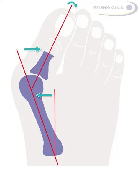 Hallux valgus &#8211; causes, symptoms and surgical treatment