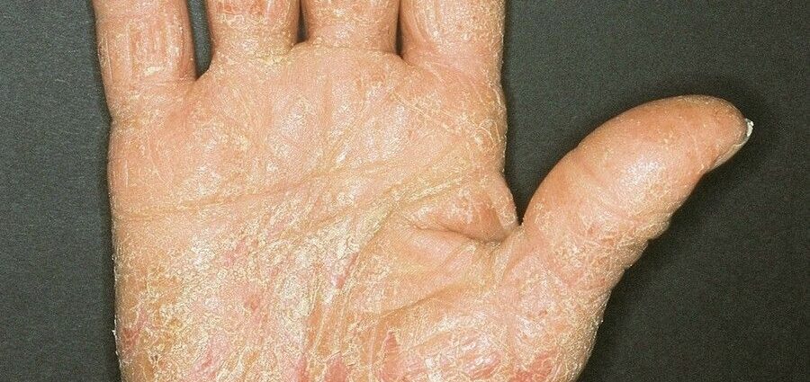 Hand and foot hyperkeratotic eczema &#8211; symptoms and treatment