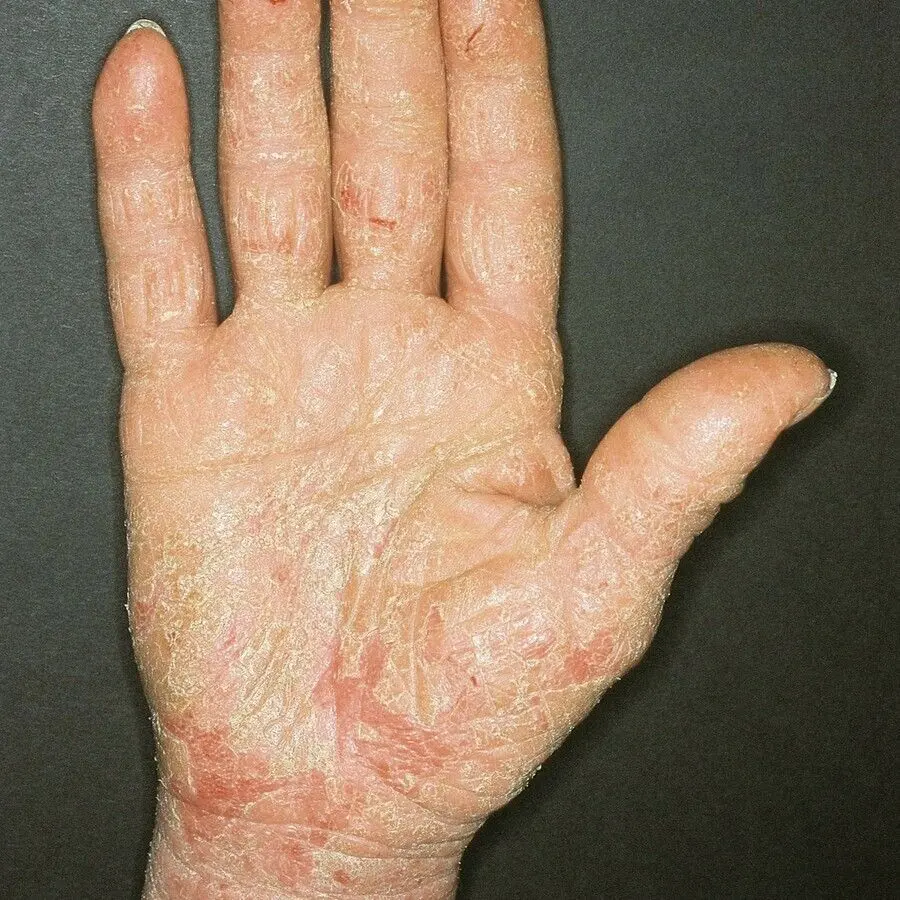 Hand and foot hyperkeratotic eczema &#8211; symptoms and treatment