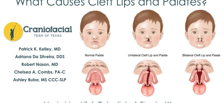 Hare lip &#8211; causes, diagnosis and treatment