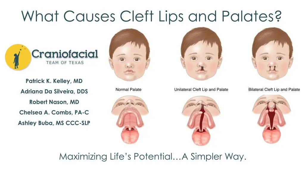 Hare lip &#8211; causes, diagnosis and treatment