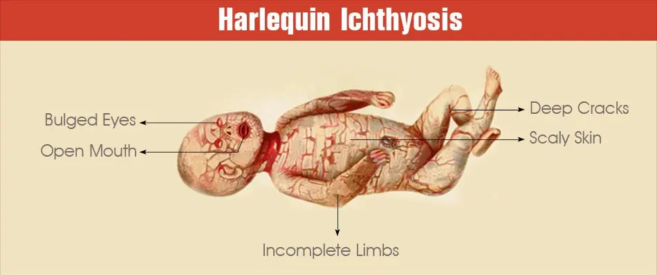 Harlequin fetus &#8211; causes, symptoms, complications, treatment