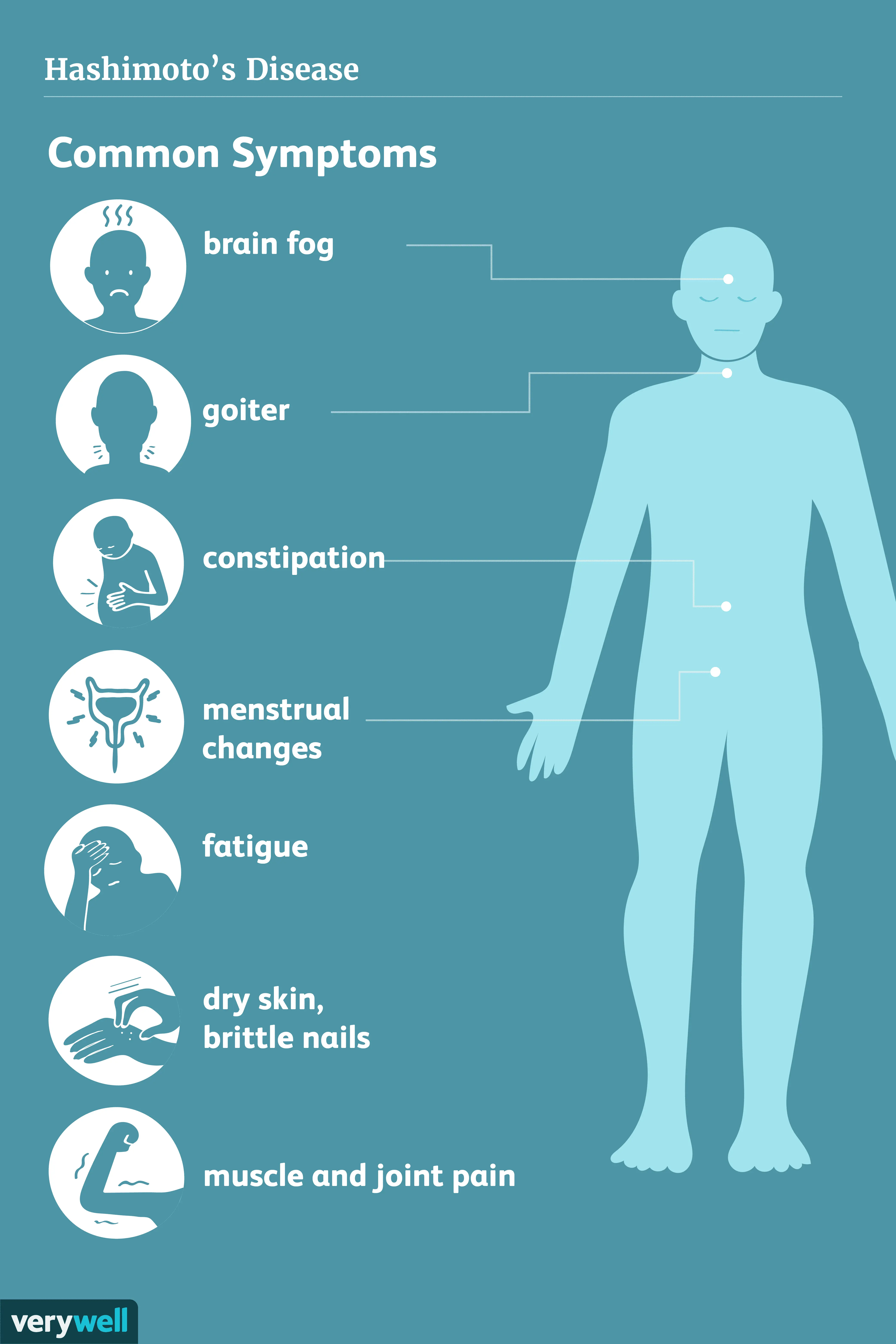 Hashimoto symptoms &#8211; find out how to recognize the disease