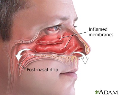 Have a runny nose up to the nostrils