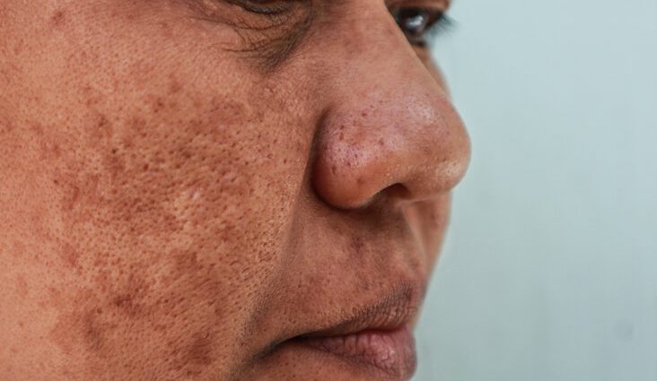 Have you noticed dark spots on your face? You may be suffering from chloasma