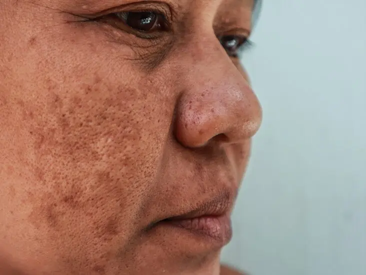 Have you noticed dark spots on your face? You may be suffering from chloasma