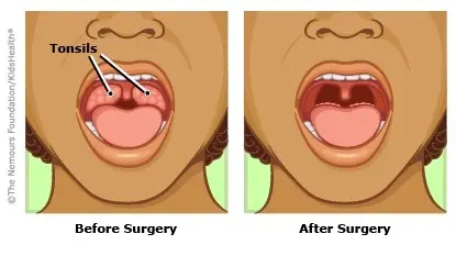 Having a child&#8217;s tonsils removed can protect their heart