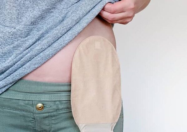 He has had a stoma since the age of 18. &#8220;I was not ashamed it would be a sack&#8221;