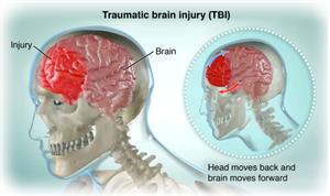 Head injuries can be detected months after concussion