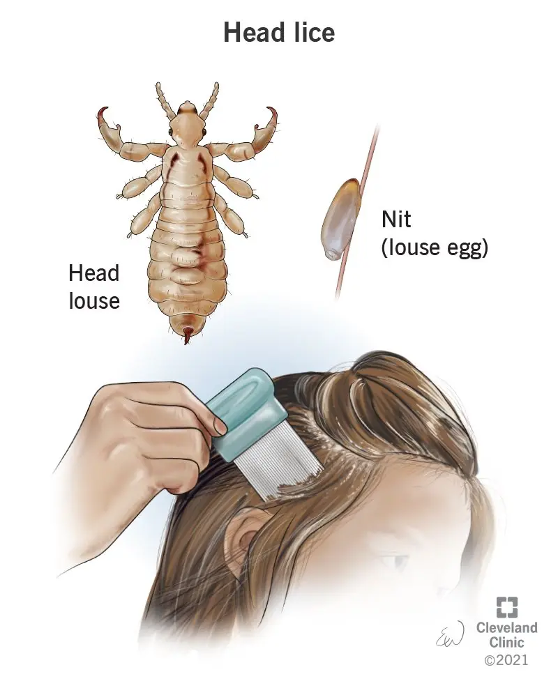 Head lice &#8211; symptoms, diagnosis, treatment. How to prevent head lice?