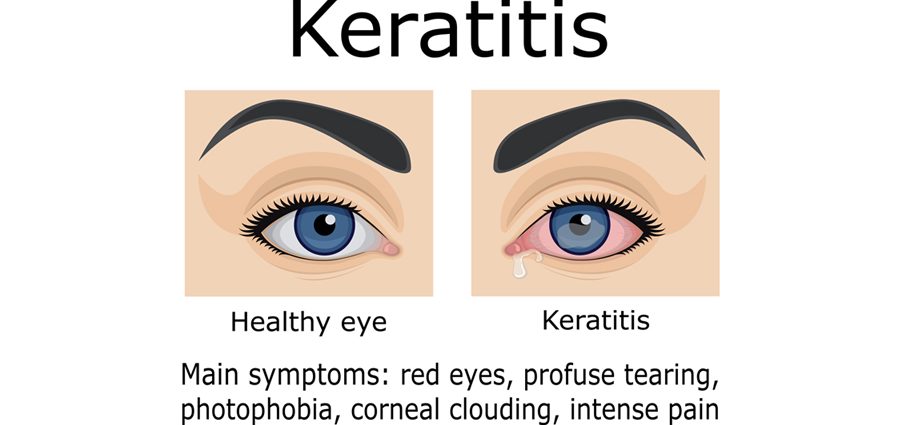 Headaches and eye diseases. Keratitis, iritis, glaucoma