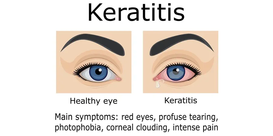 Headaches and eye diseases. Keratitis, iritis, glaucoma