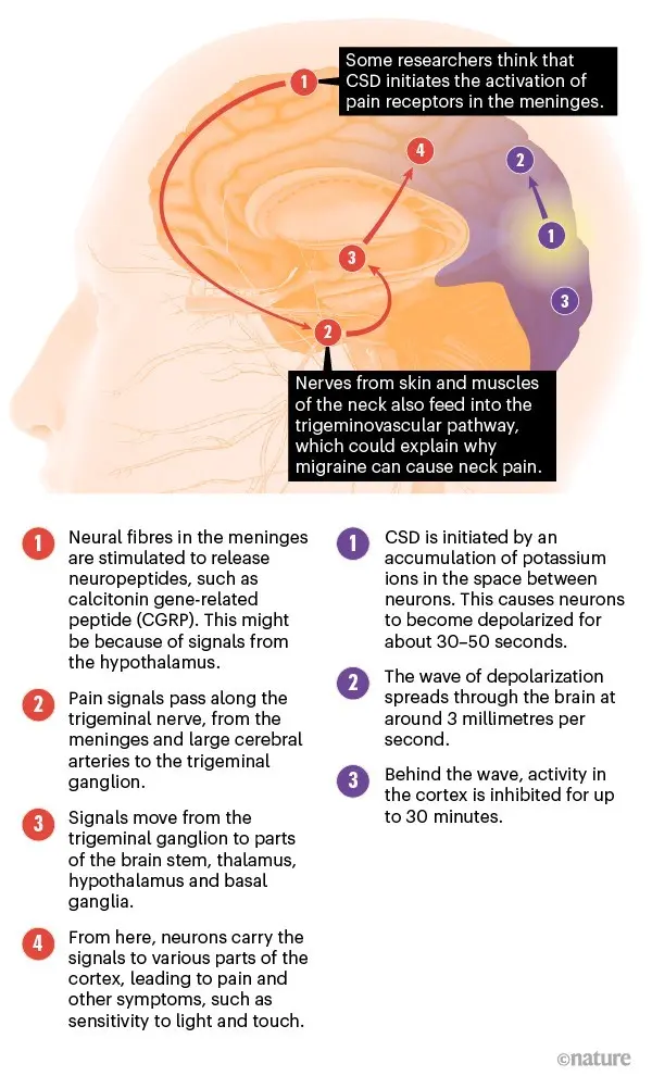 Headaches of migraine origin &#8211; symptoms, causes, treatment. How to prevent migraines?