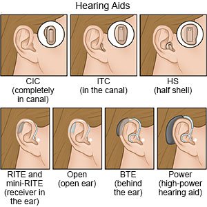 Hearing aid &#8211; structure and types. How to choose a hearing aid? [WE EXPLAIN]