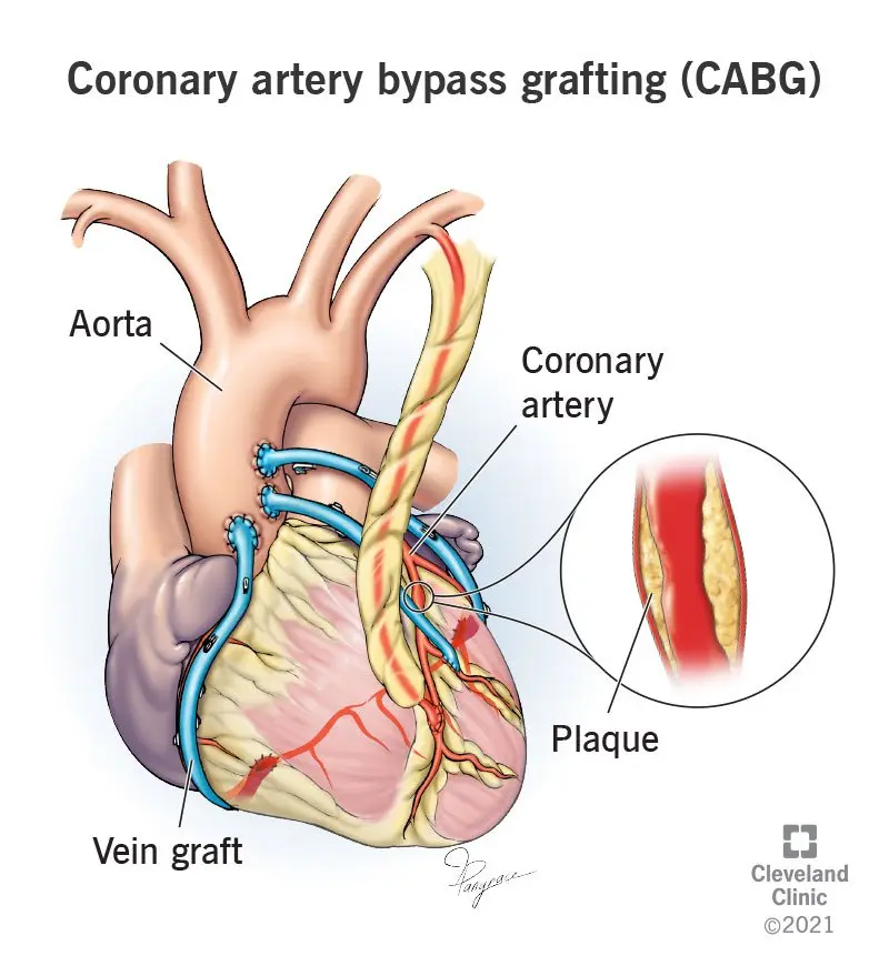 Heart bypass surgery &#8211; what is it and when is it worth to undergo bypass surgery?