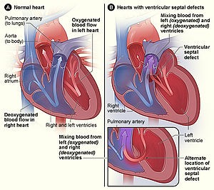 Heart defects