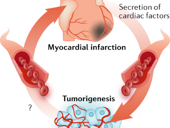 Heart failure predisposes you to cancer