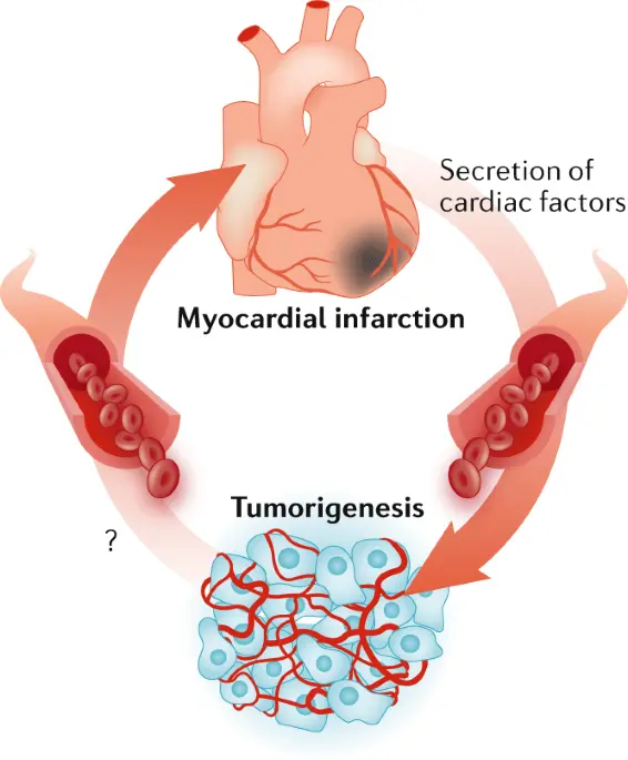 Heart failure predisposes you to cancer