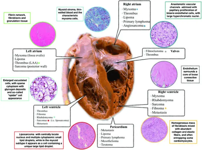 Heart tumors &#8211; symptoms, diagnosis, treatment