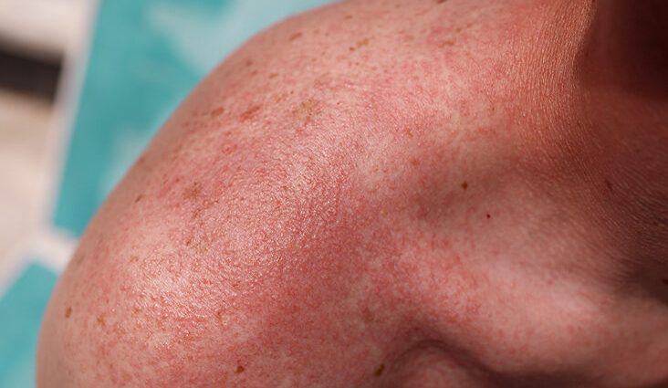 Heat Rash Causes Types Symptoms Treatment We Explain Healthy