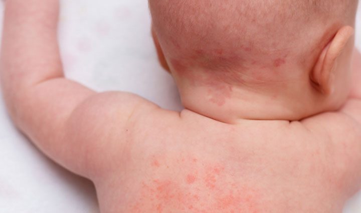 Heat rash in an infant &#8211; symptoms, causes, treatment